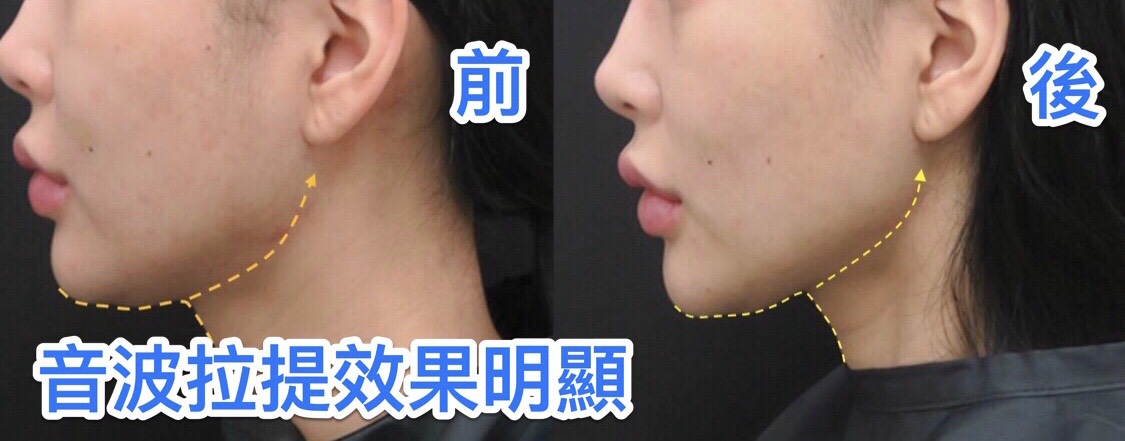 音波拉提下顎線條前後對比 — 效果明顯