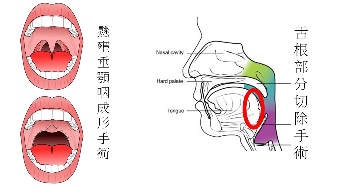 懸壅垂顎咽成形手術(UPPP)與舌根部分切除手術示意圖