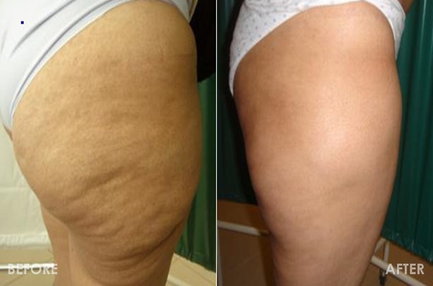 消脂針瘦大腿瘦馬鞍橘皮組織