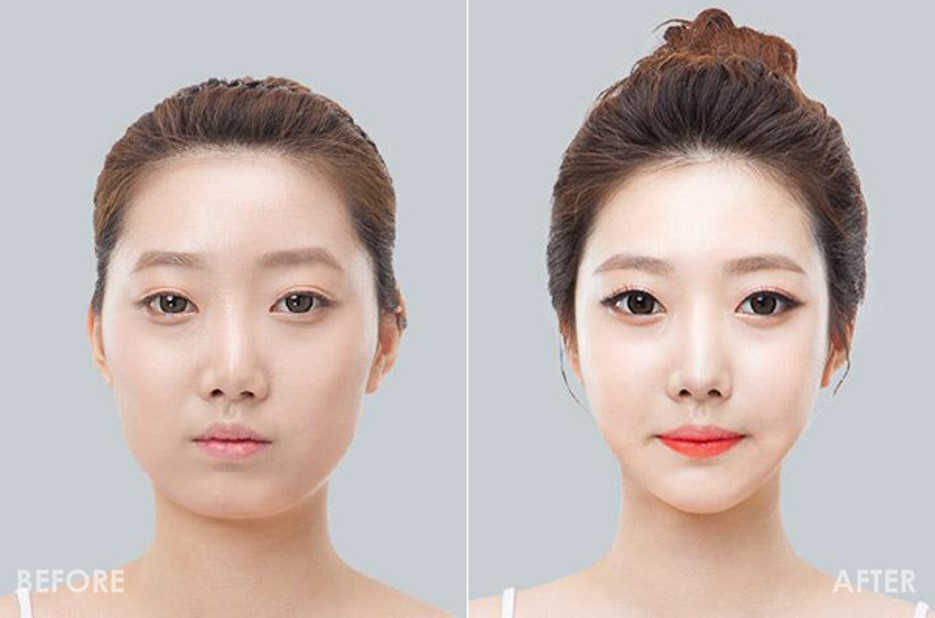 消脂針雙下巴小臉瘦臉