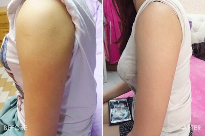 消脂針瘦手臂瘦蝴蝶袖瘦上手臂