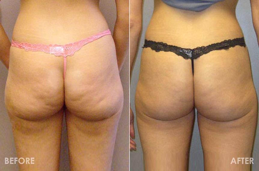 消脂針瘦臀部微笑線屁股下垂提升