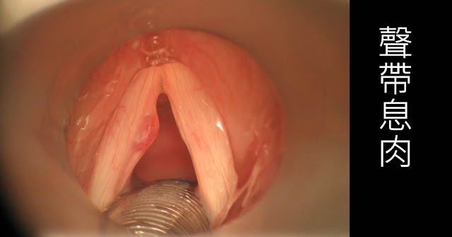 聲帶息肉喉內視鏡實際影像