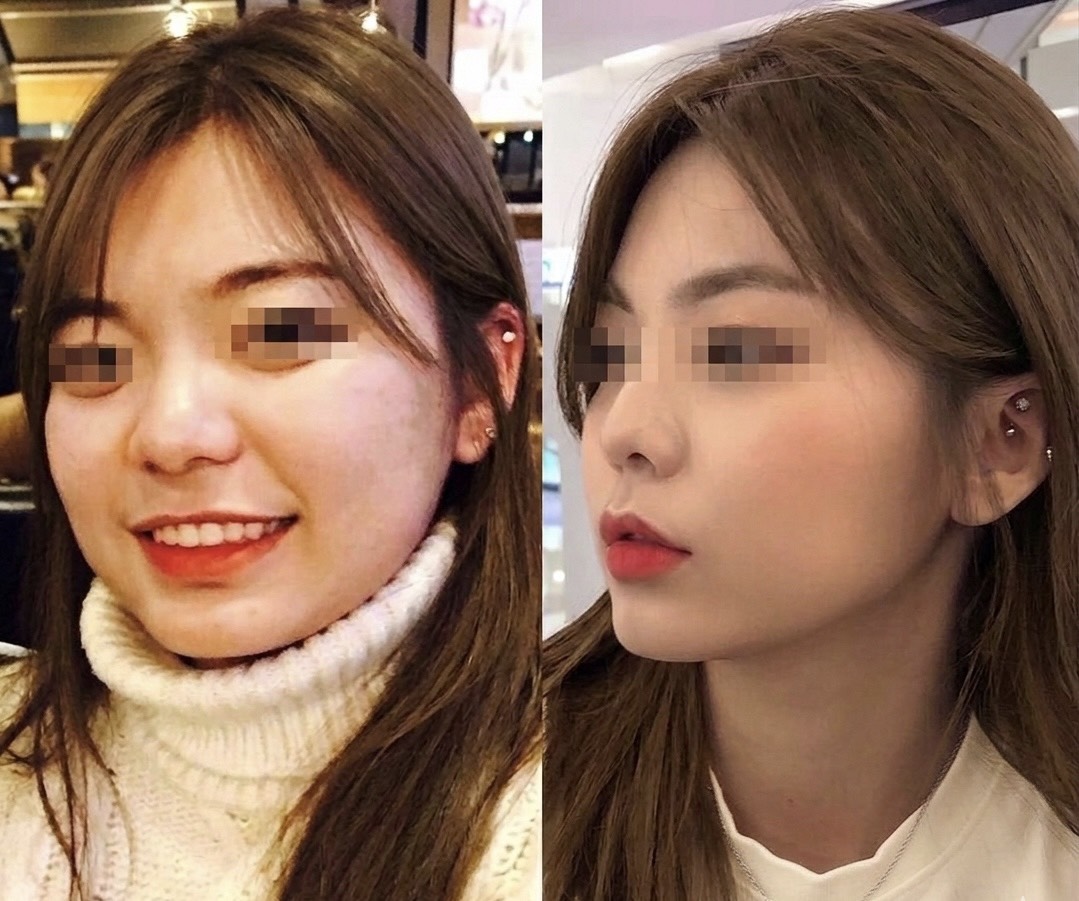 肉毒咬肌搭配音波拉提與消脂針前後對比 — V臉雕塑效果