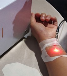 靜脈雷射施打時手部照片