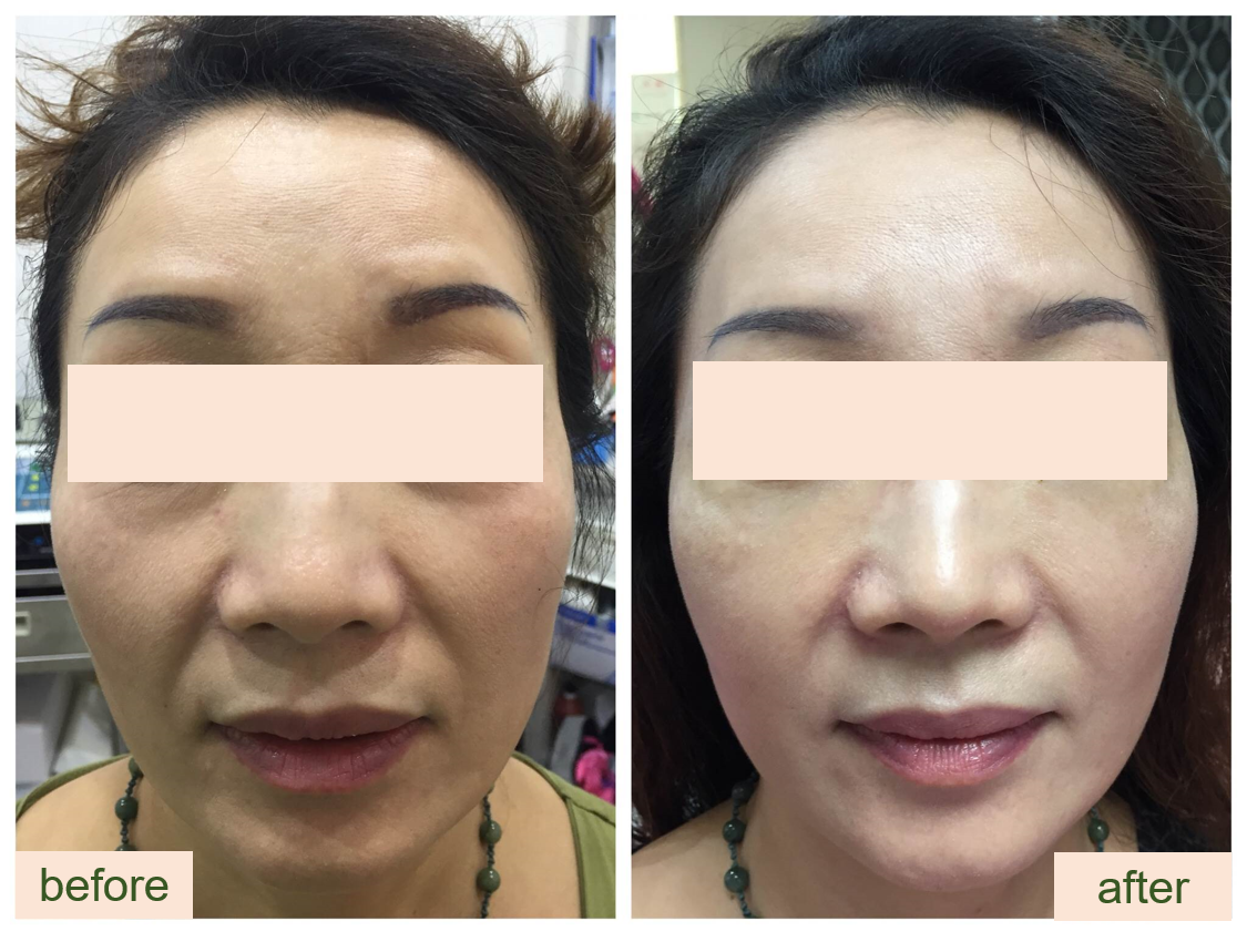 音波拉提前後對比 — 施打單邊即可看出差異