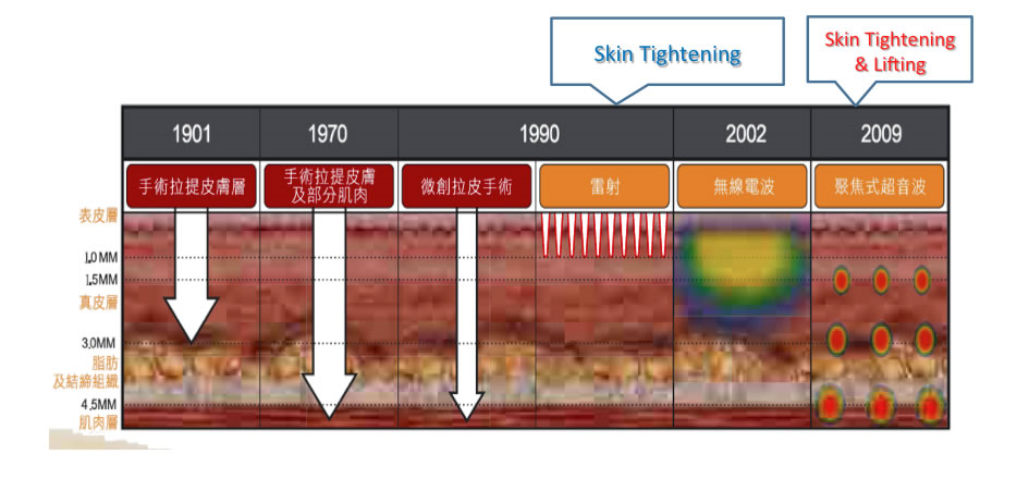 音波拉提作用於皮膚深層SMAS筋膜層示意圖