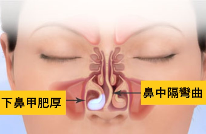 下鼻甲肥厚與鼻中隔彎曲示意圖